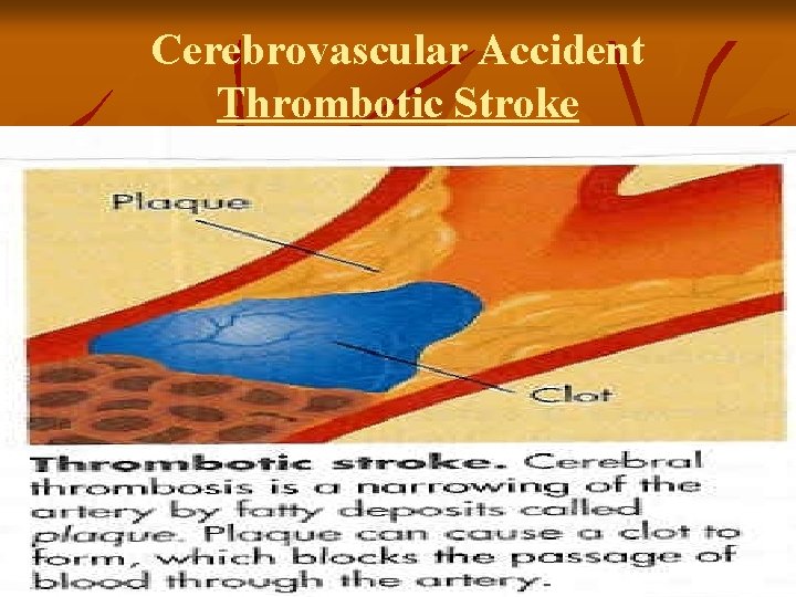 Cerebrovascular Accident Thrombotic Stroke 