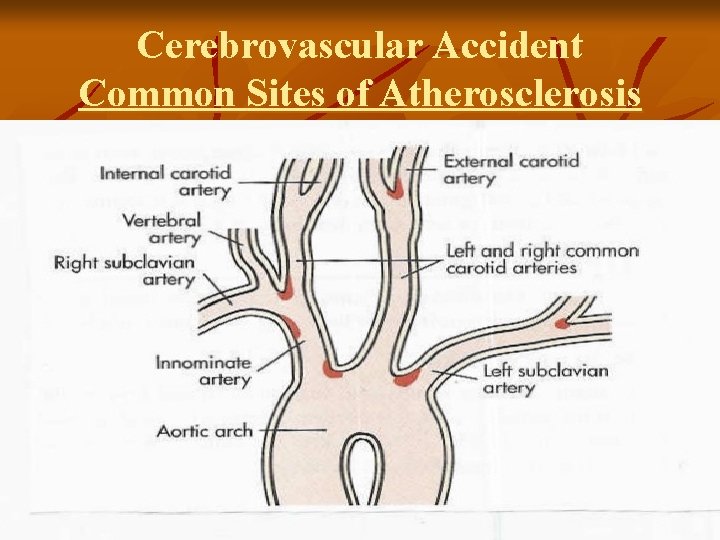 Cerebrovascular Accident Common Sites of Atherosclerosis 