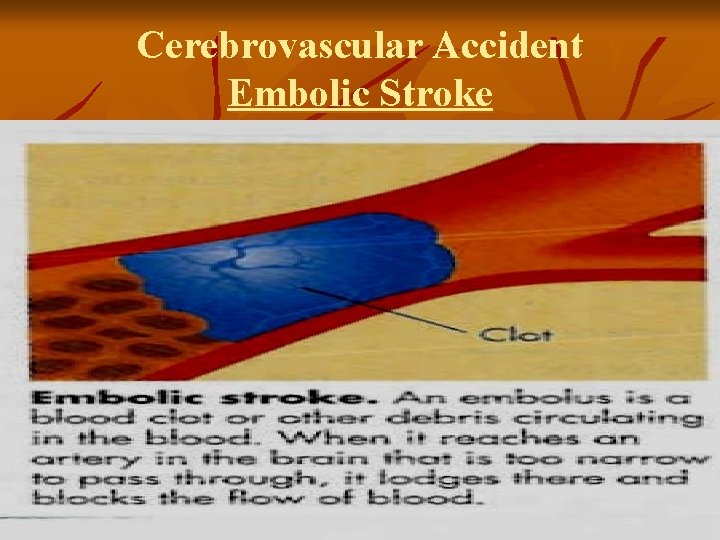 Cerebrovascular Accident Embolic Stroke 