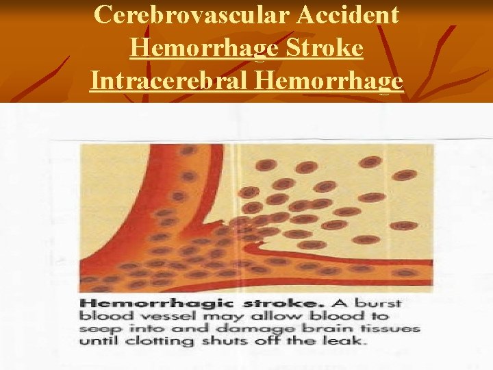 Cerebrovascular Accident Hemorrhage Stroke Intracerebral Hemorrhage 