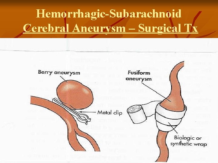 Hemorrhagic-Subarachnoid Cerebral Aneurysm – Surgical Tx 