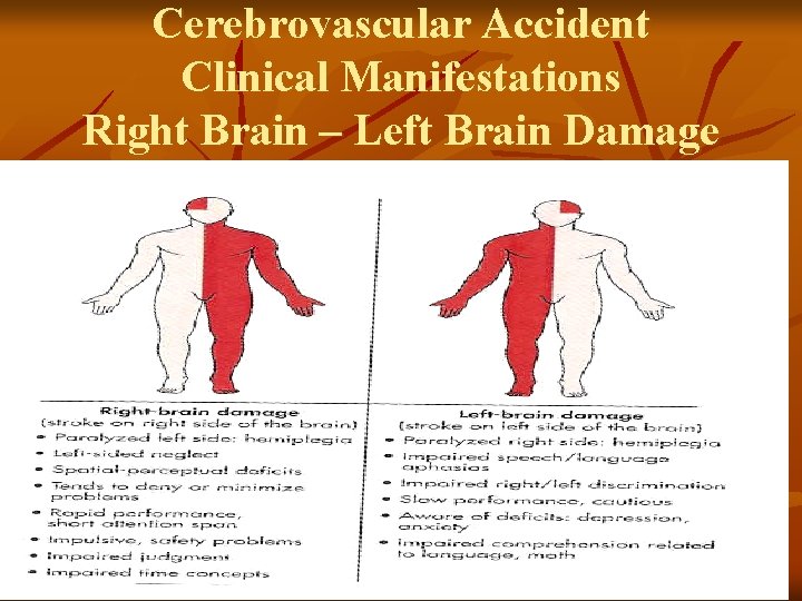 Cerebrovascular Accident Clinical Manifestations Right Brain – Left Brain Damage 