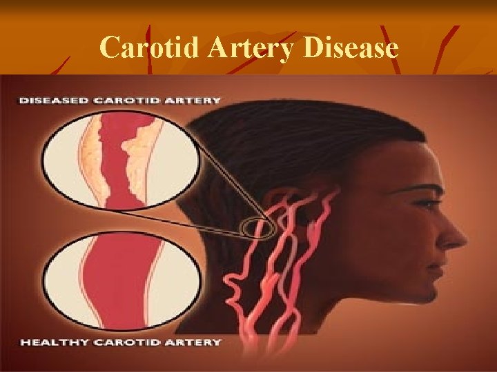 Carotid Artery Disease 
