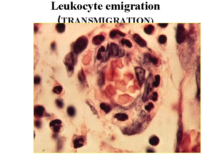 Leukocyte emigration (TRANSMIGRATION) 