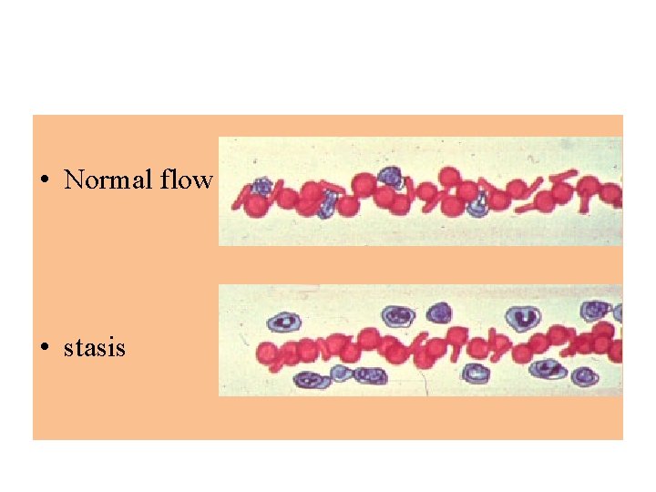  • Normal flow • stasis 