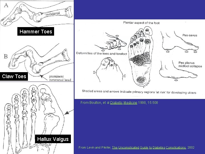 Hammer Toes Claw Toes From Boulton, et al Diabetic Medicine 1998, 15: 508 Hallux