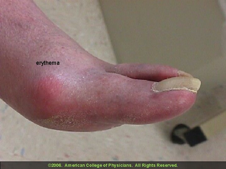 erythema © 2006. American College of Physicians. All Rights Reserved. 