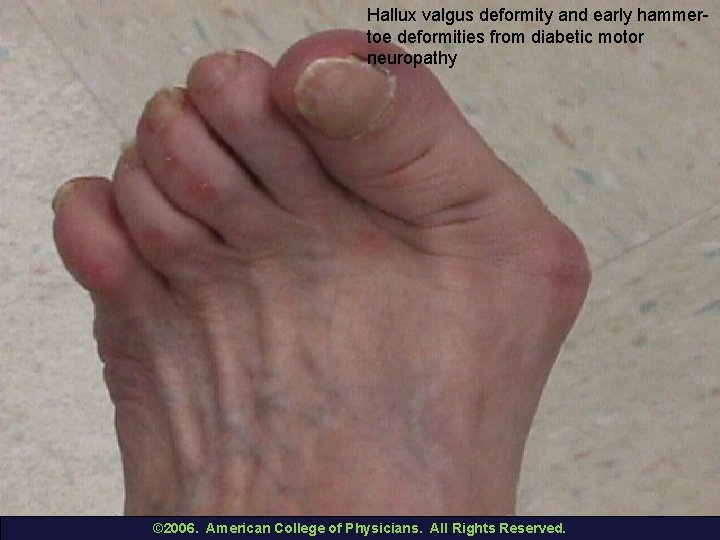 Hallux valgus deformity and early hammertoe deformities from diabetic motor neuropathy © 2006. American