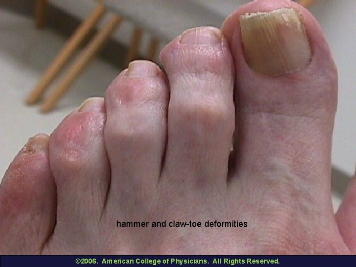 hammer and claw-toe deformities © 2006. American College of Physicians. All Rights Reserved. 