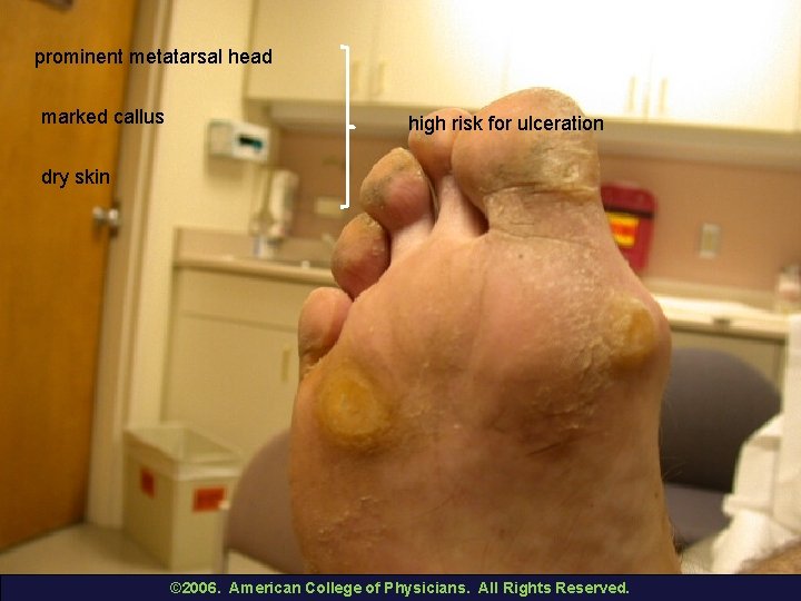 prominent metatarsal head marked callus high risk for ulceration dry skin © 2006. American