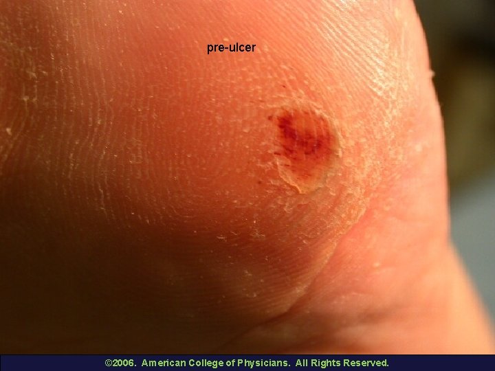 pre-ulcer © 2006. American College of Physicians. All Rights Reserved. 