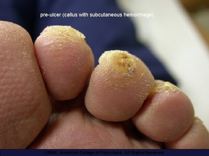 pre-ulcer (callus with subcutaneous hemorrhage) © 2006. American College of Physicians. All Rights Reserved.