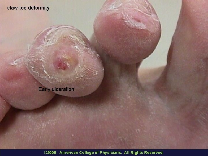 claw-toe deformity Early ulceration © 2006. American College of Physicians. All Rights Reserved. 