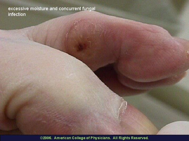 excessive moisture and concurrent fungal infection © 2006. American College of Physicians. All Rights
