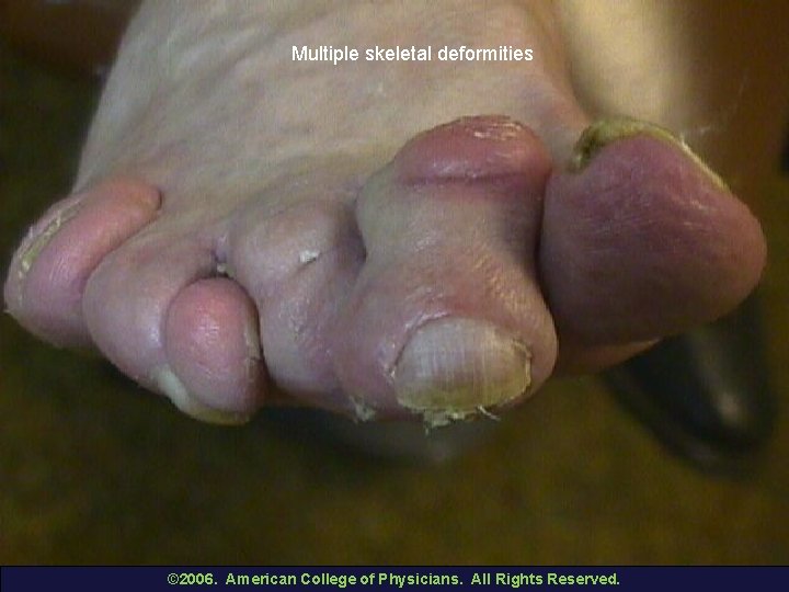 Multiple skeletal deformities © 2006. American College of Physicians. All Rights Reserved. 