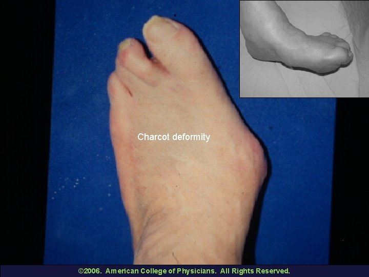 Charcot deformity © 2006. American College of Physicians. All Rights Reserved. 