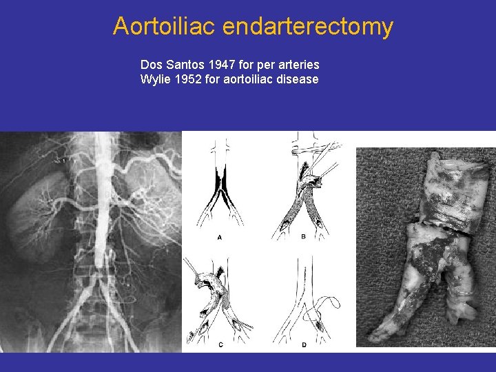 Aortoiliac endarterectomy Dos Santos 1947 for per arteries Wylie 1952 for aortoiliac disease 