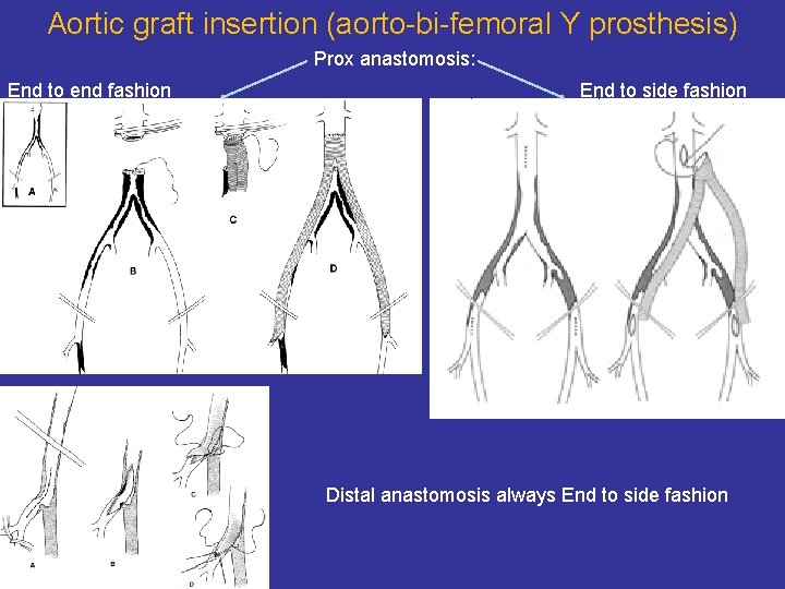 Aortic graft insertion (aorto-bi-femoral Y prosthesis) Prox anastomosis: End to end fashion End to