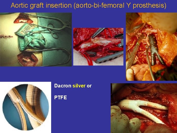 Aortic graft insertion (aorto-bi-femoral Y prosthesis) Dacron silver or PTFE 