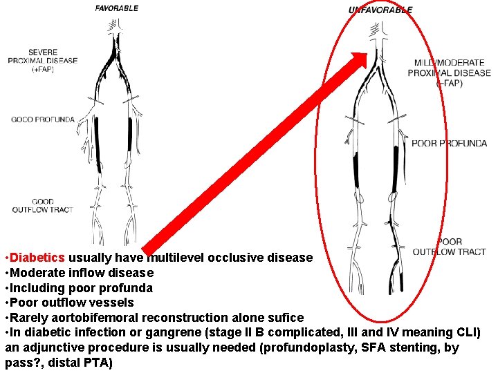  • Diabetics usually have multilevel occlusive disease • Moderate inflow disease • Including