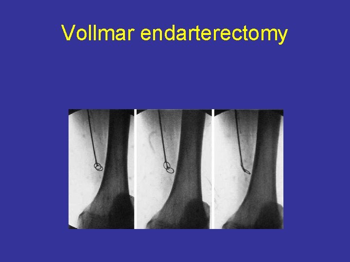 Vollmar endarterectomy 