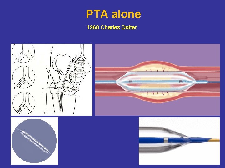 PTA alone 1968 Charles Dotter 