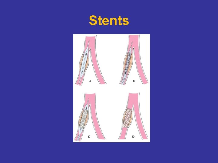 Stents 