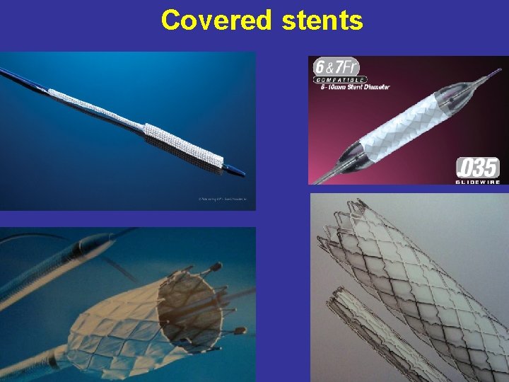 Covered stents 