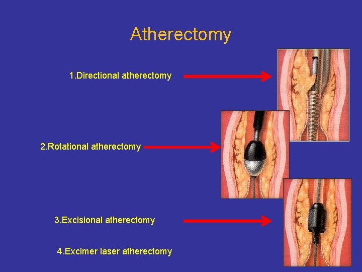 Atherectomy 1. Directional atherectomy 2. Rotational atherectomy 3. Excisional atherectomy 4. Excimer laser atherectomy