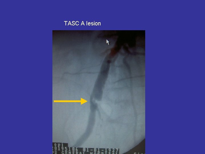 TASC A lesion 