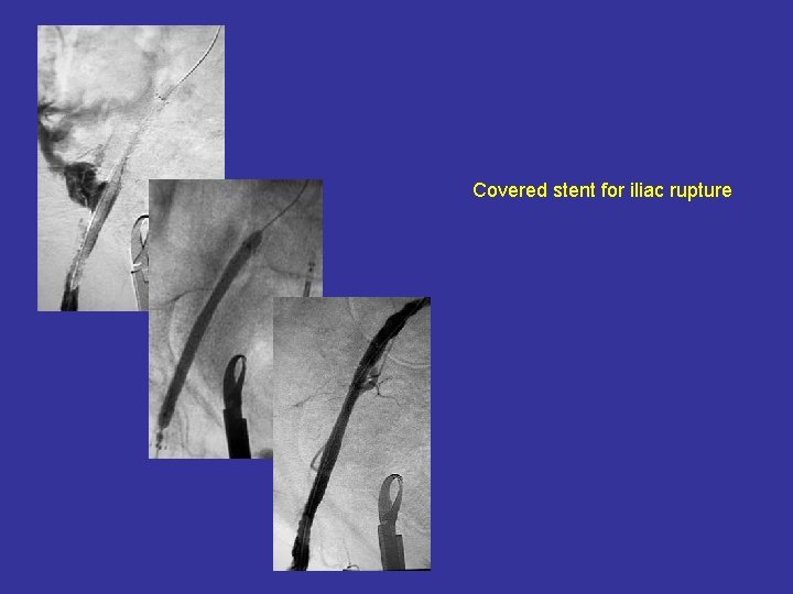 Covered stent for iliac rupture 