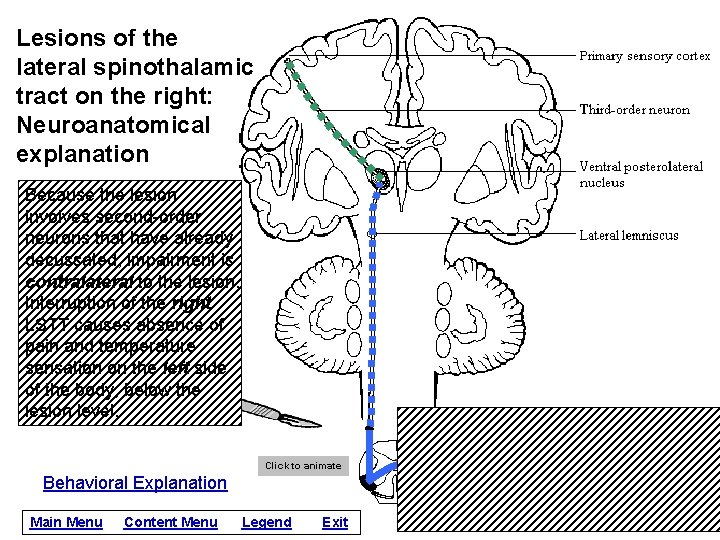 Lesions of the lateral spinothalamic tract on the right: Neuroanatomical explanation Because the lesion