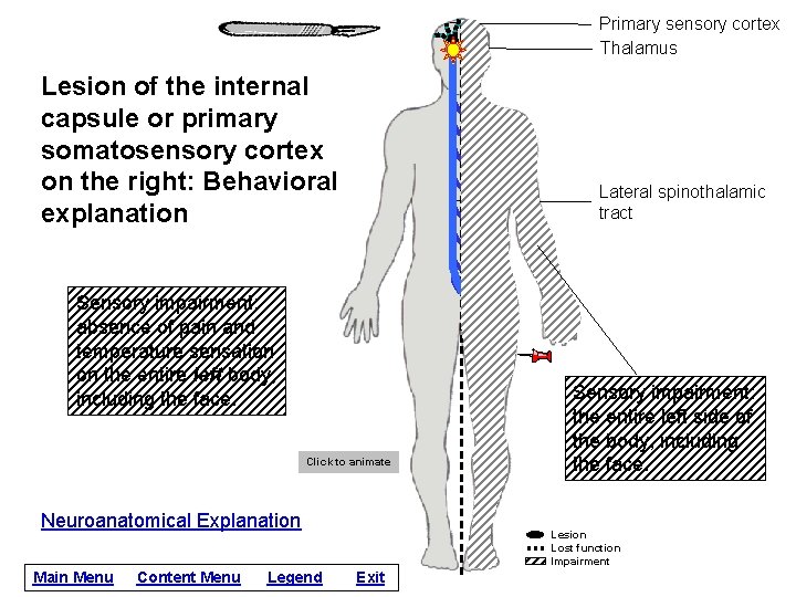 Primary sensory cortex Thalamus Lesion of the internal capsule or primary somatosensory cortex on