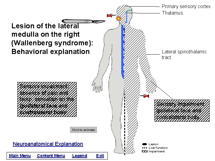 Primary sensory cortex Thalamus Lesion of the lateral medulla on the right (Wallenberg syndrome):