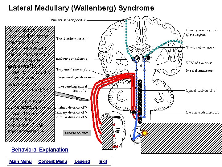 Lateral Medullary (Wallenberg) Syndrome Because the lesion involves first-order neurons in the trigeminal system