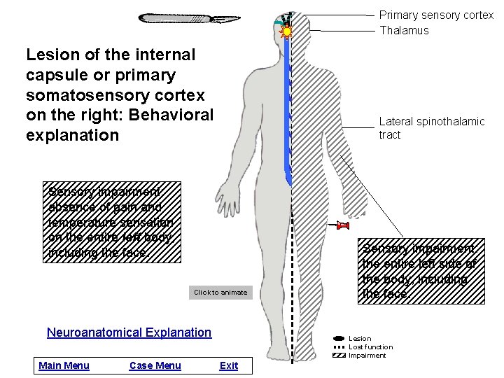 Primary sensory cortex Thalamus Lesion of the internal capsule or primary somatosensory cortex on