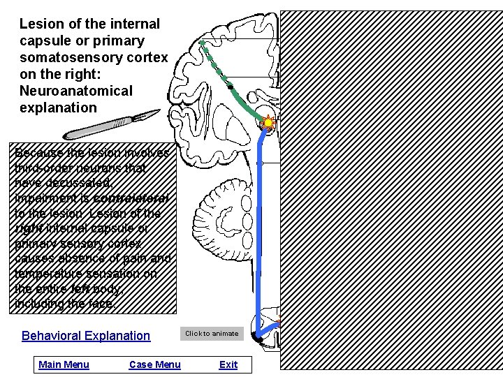 Lesion of the internal capsule or primary somatosensory cortex on the right: Neuroanatomical explanation
