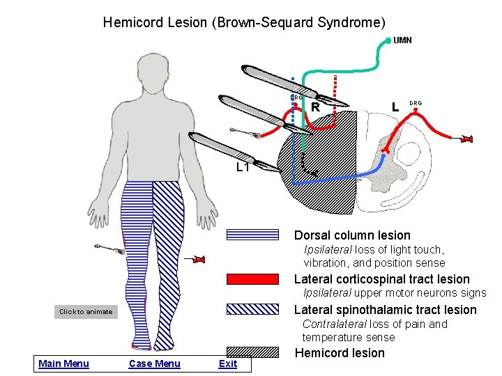 Hemicord Lesion (Brown-Sequard Syndrome) UMN DRG R L DRG L 1 Dorsal column lesion
