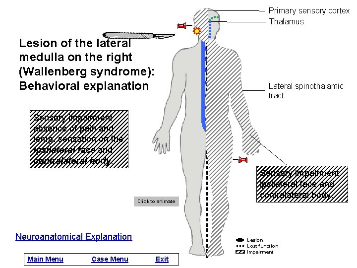 Primary sensory cortex Thalamus Lesion of the lateral medulla on the right (Wallenberg syndrome):