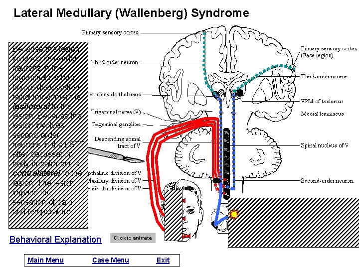 Lateral Medullary (Wallenberg) Syndrome Because the lesion involves first-order neurons in the trigeminal system