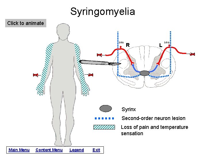 Syringomyelia Click to animate DRG R L DRG Syrinx Second-order neuron lesion Loss of