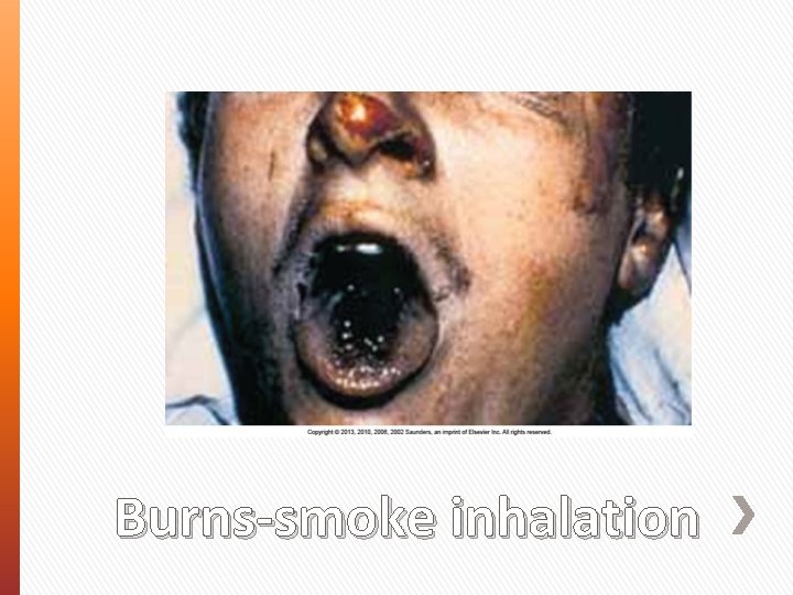Burns-smoke inhalation 