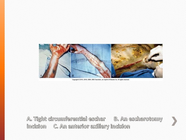 A. Tight circumferential eschar B. An escharotomy incision C. An anterior axillary incision 