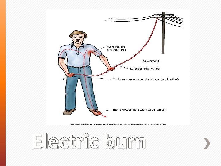 Electric burn 