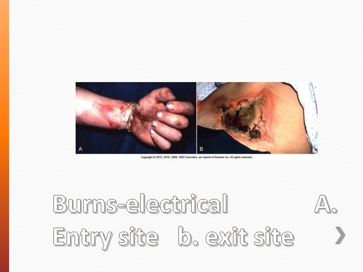 Burns-electrical A. Entry site b. exit site 