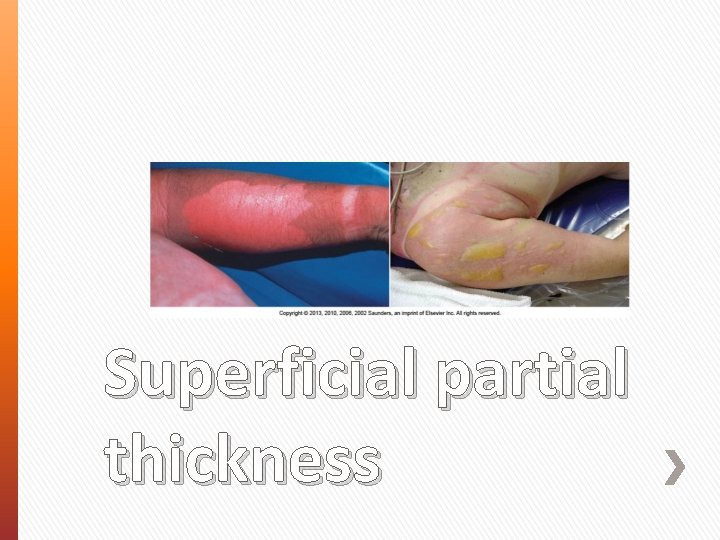 Superficial partial thickness 