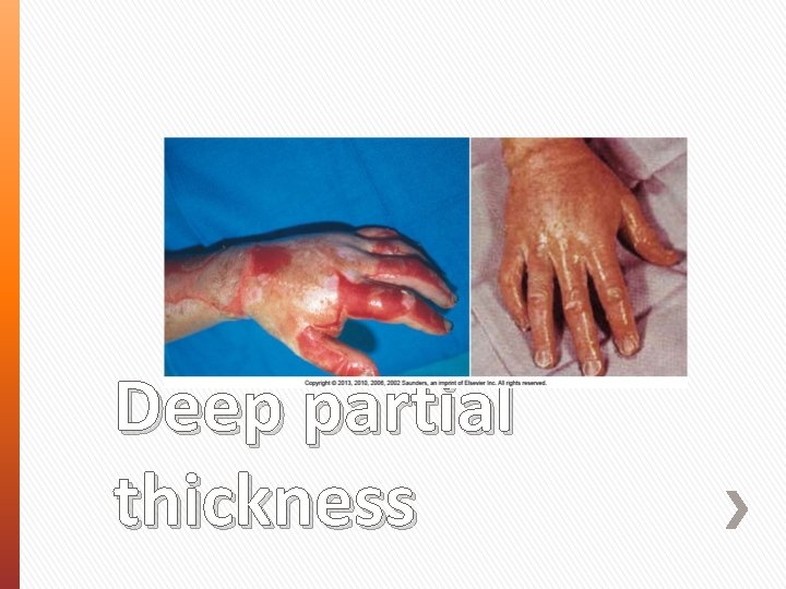 Deep partial thickness 