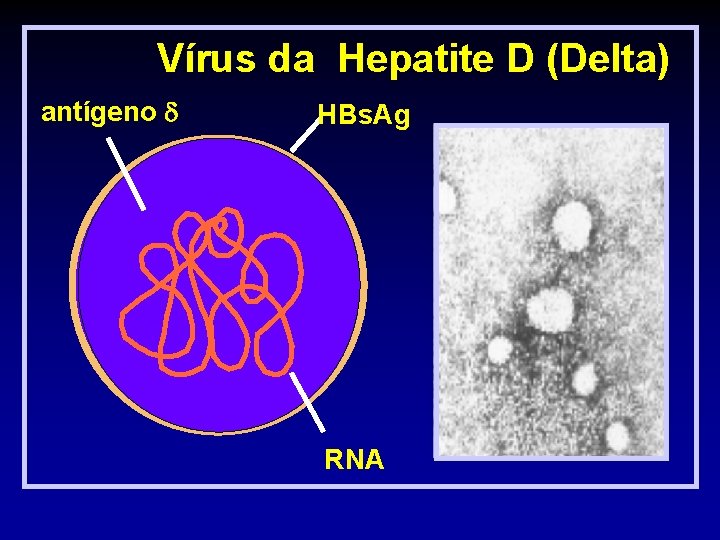 Vírus da Hepatite D (Delta) antígeno HBs. Ag RNA 