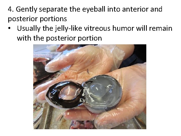 4. Gently separate the eyeball into anterior and posterior portions • Usually the jelly-like