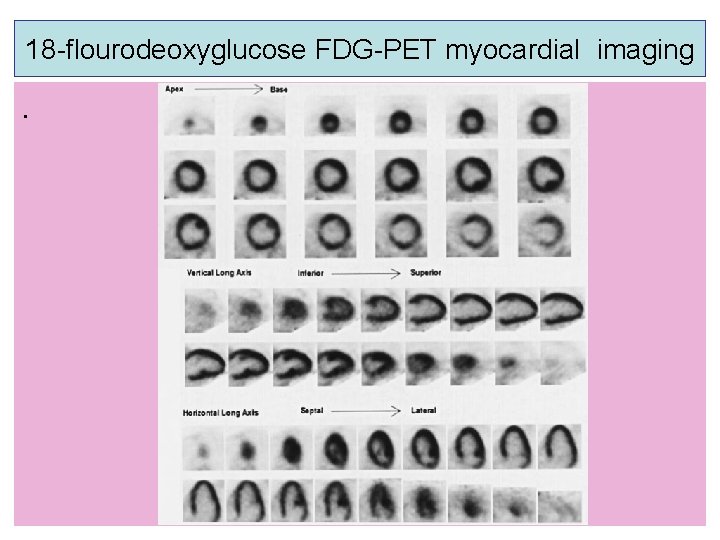 18 -flourodeoxyglucose FDG-PET myocardial imaging . 